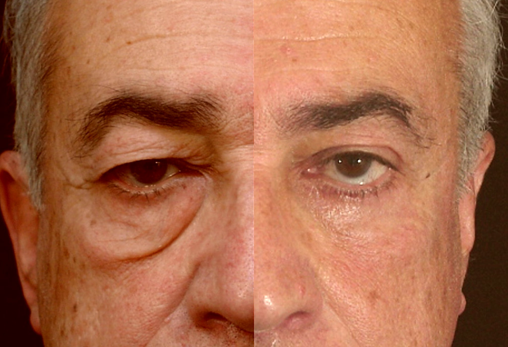 Photo avant/après d'une blépharoplastie chez un homme (1/2 face)
