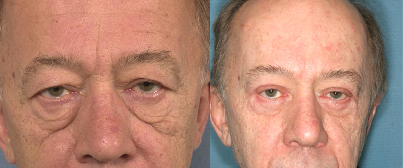 Blépharoplastie chez un homme (1/2 face)