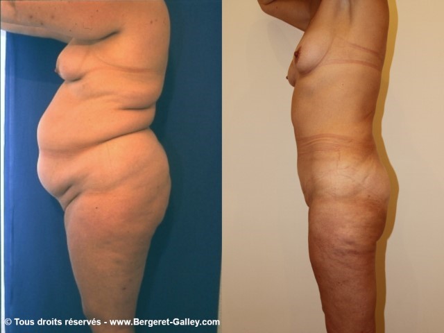 Bodylift