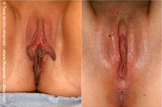 Labiaplasty with reducion of the inner labias and lipofilling of the outer ...