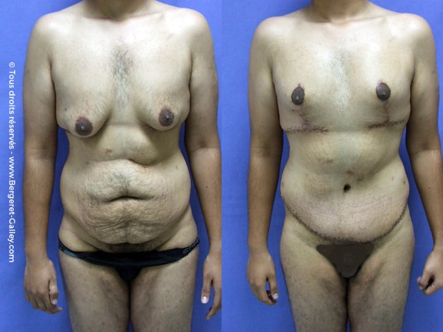 gynecomastia a prostatitis miatt kashtan prostatitis