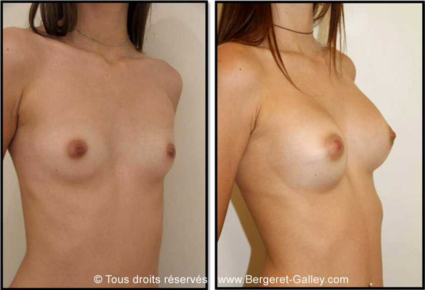 Breast enlargement with  implants