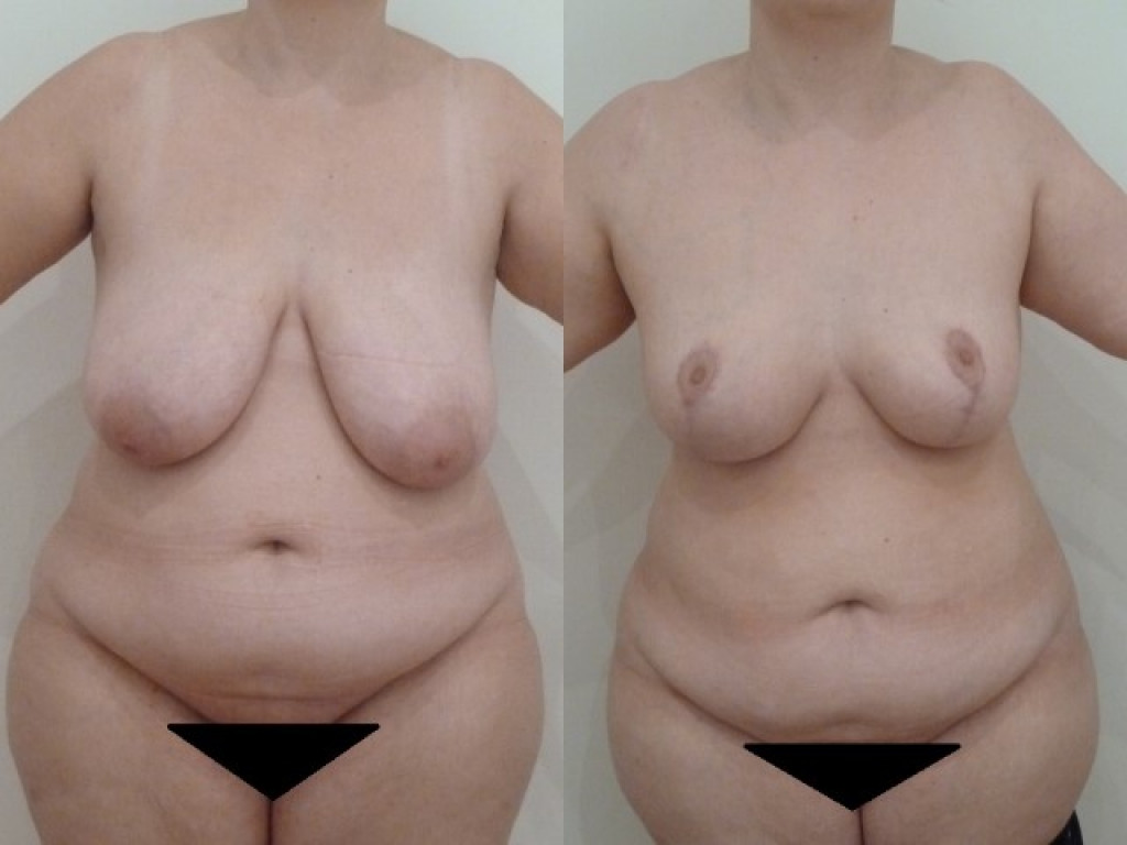 Breast reduction