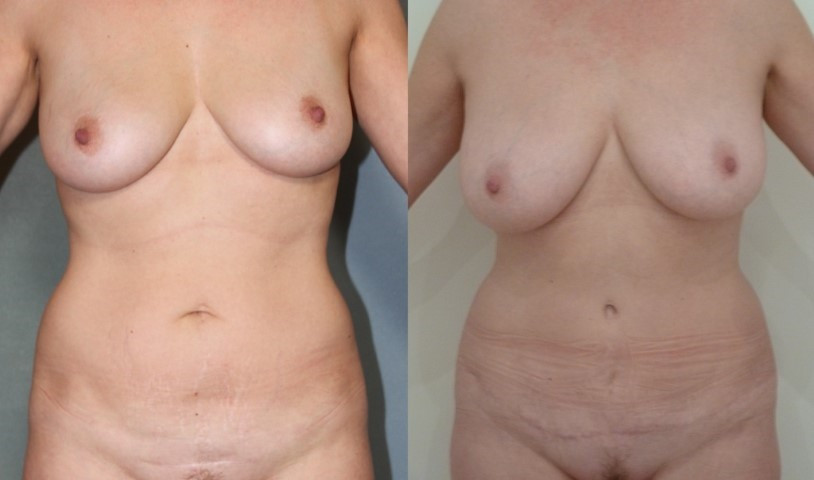 abdominoplastie