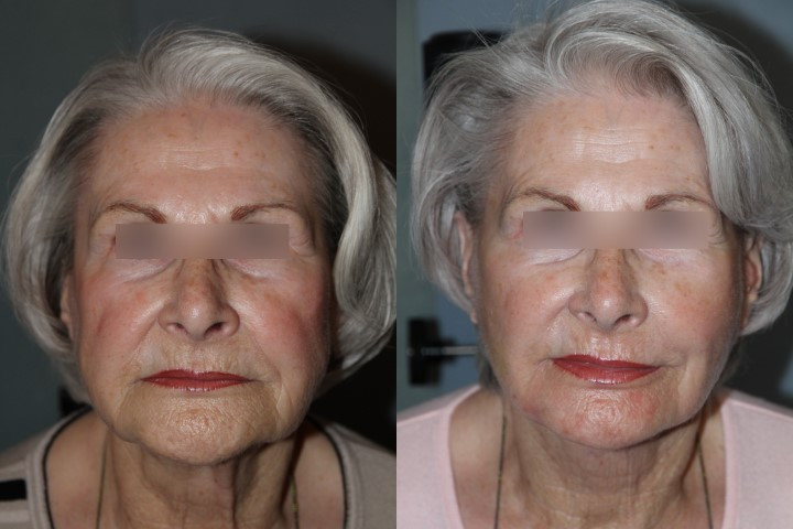 chirurgie lifting visage avant après