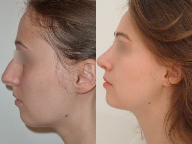 Résultat avant/après rhinoplastie