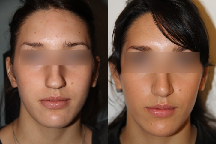 De face avant et après opération Rhinoplastie