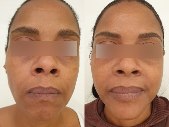 Lipofilling du visage