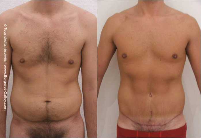 Lipoaspiration homme