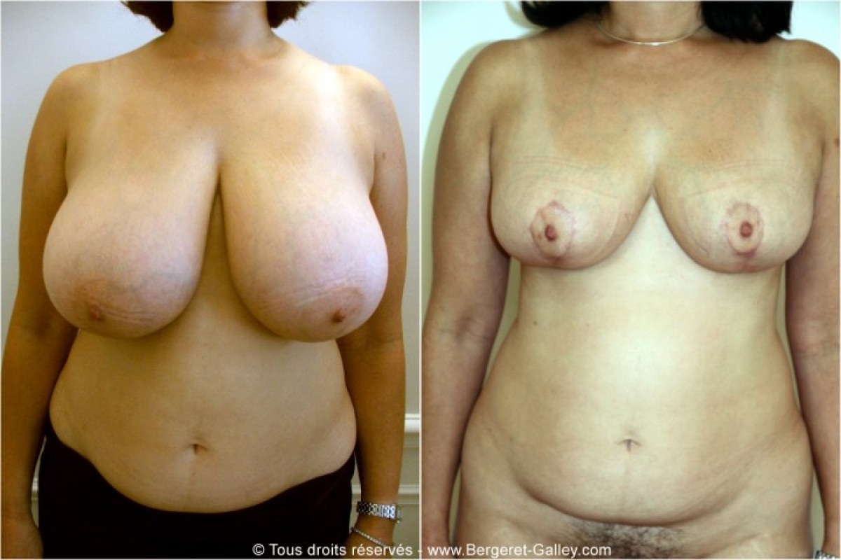 Breast reduction