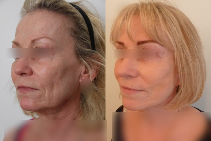 Lifting cervico-facial