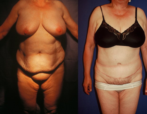 abdominoplastie