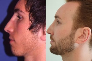 Masculinisation du visage