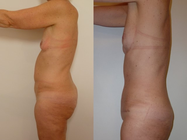 abdominoplastie