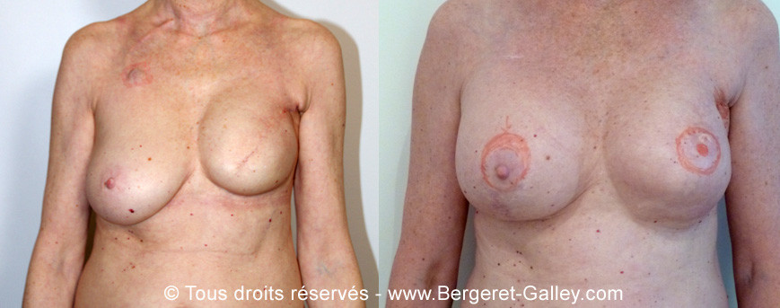 Before/After breast Reconstruction