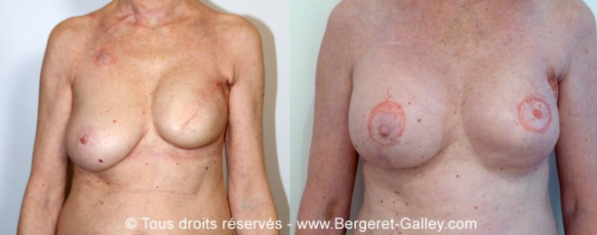 Before/After breast Reconstruction