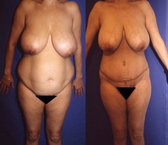 abdominoplastie