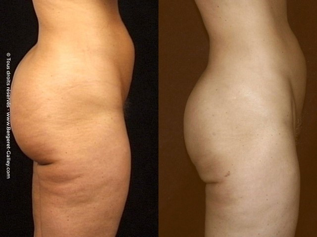 Liposuction