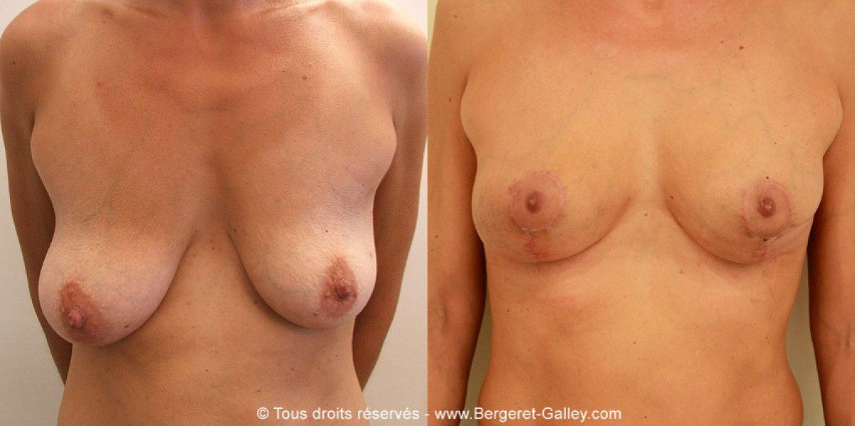 Before/After breast Reconstruction