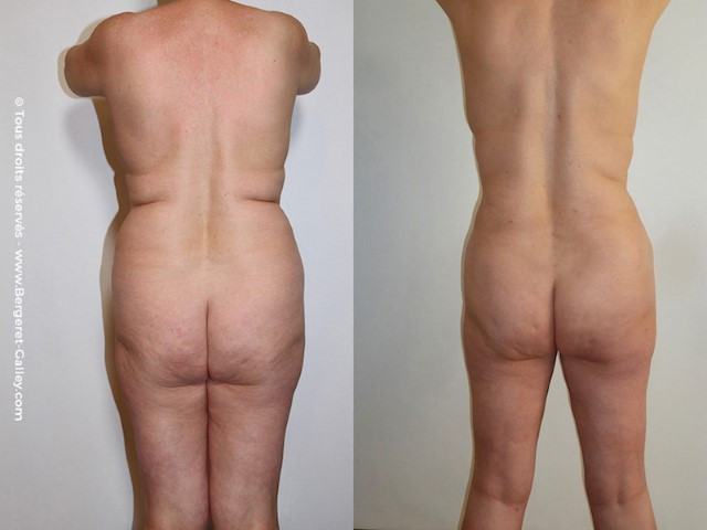 Abdominoplastie