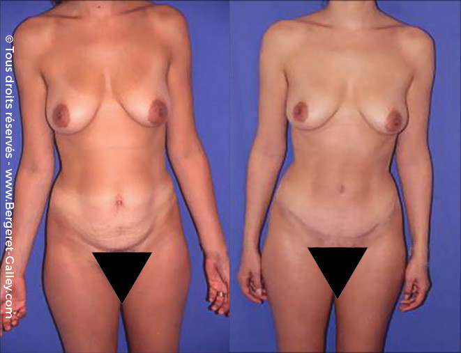 Photo avant/après d'une Plastie abdominale chez une femme de face