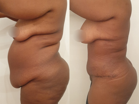 Abdominoplastie Avant/Après