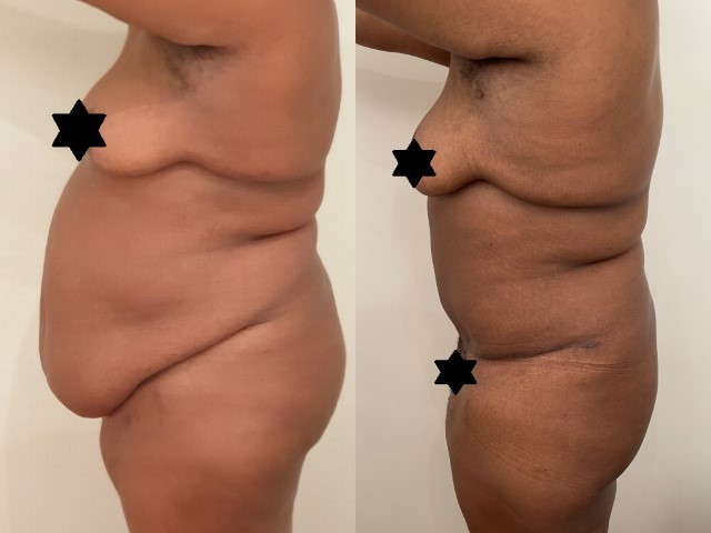 abdominoplastie