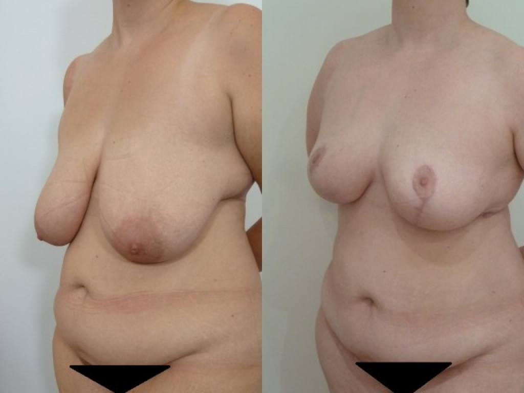 Breast reduction