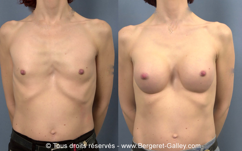 Photo avant/après augmentation mammaire avec des prothèses suite une malformation congénitale
