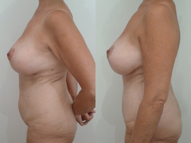 abdominoplastie