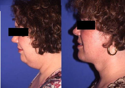 Lipoaspiration du menton