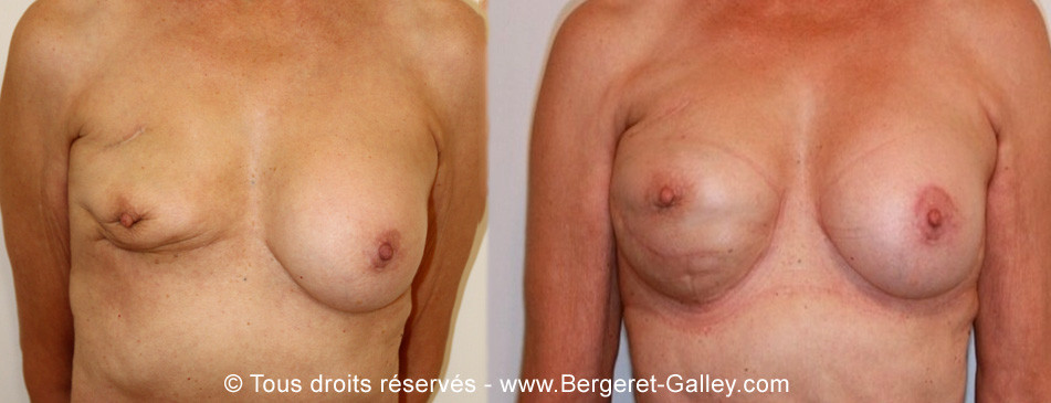 Before/After breast Reconstruction