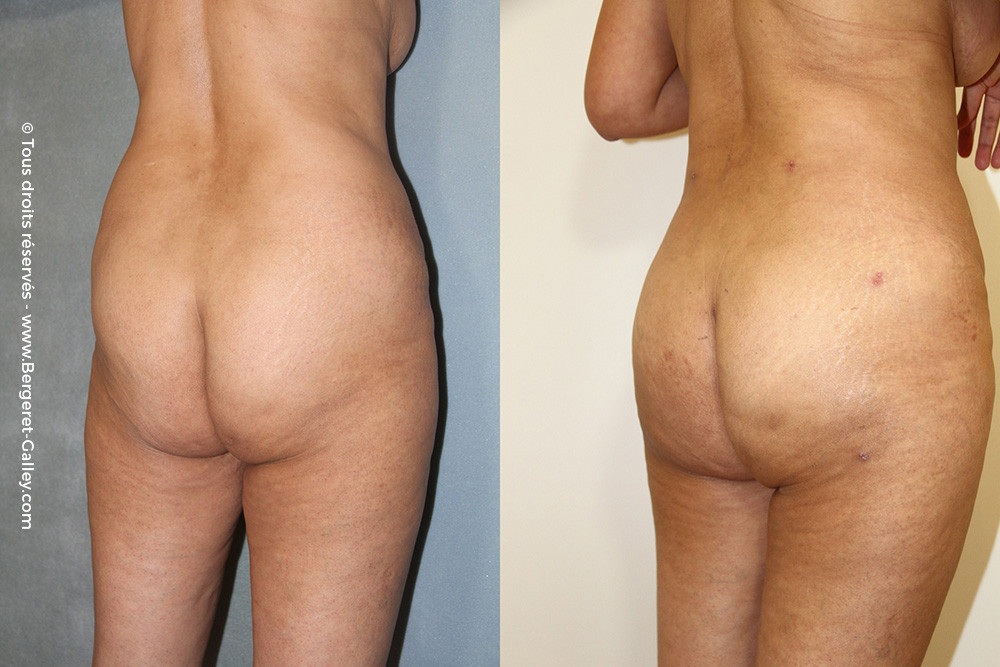 Before/After Buttocks lipofilling paris