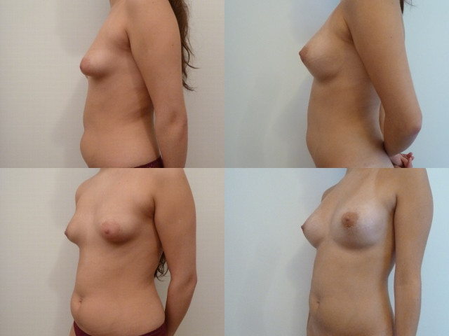 Avant/Après une augmentation mammaire par lipofilling