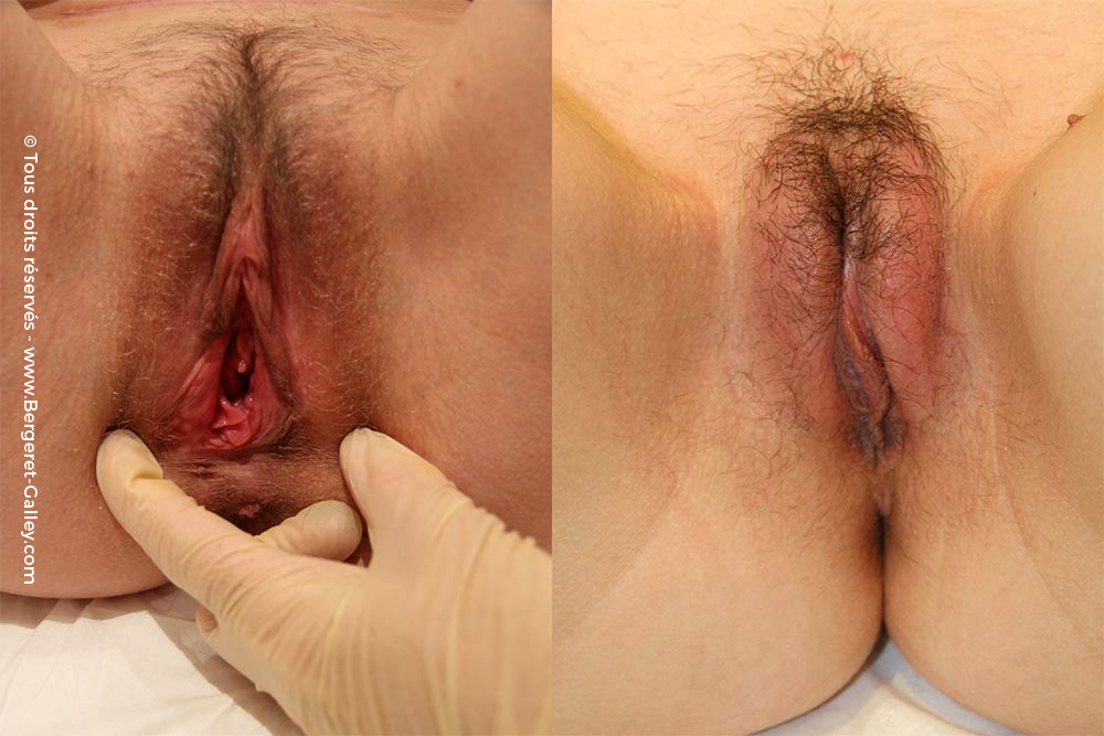 Омоложение вагины