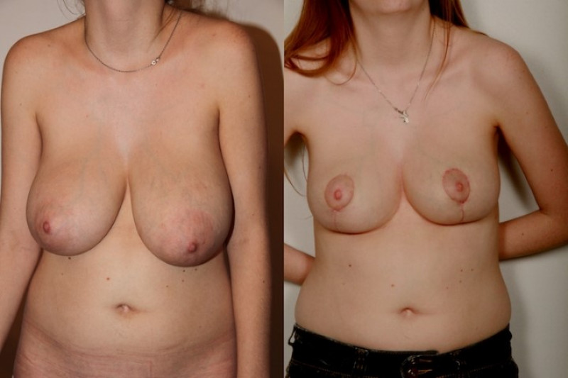 Breast reduction