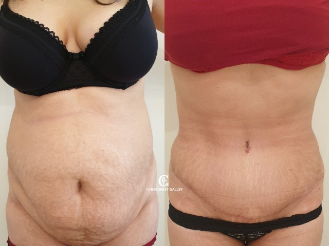 abdominoplastie