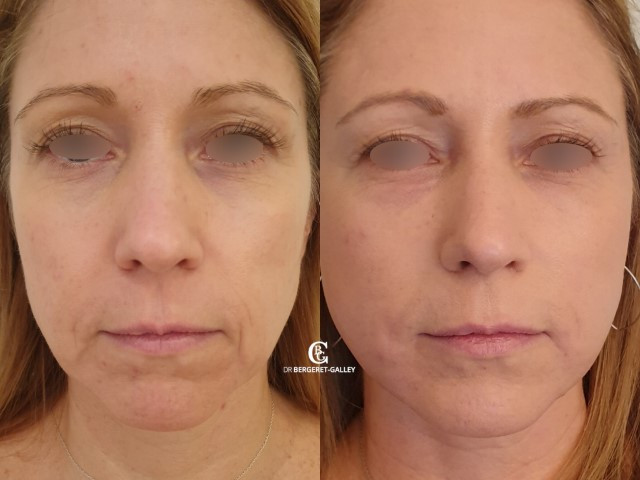 Lipofilling du visage