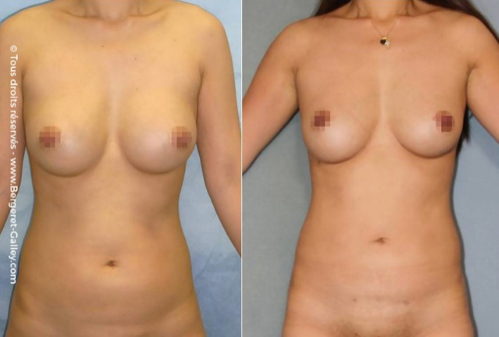 Lipofilling seins