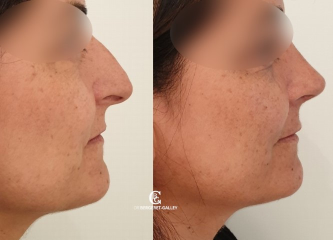 Résultat avant/après rhinoplastie