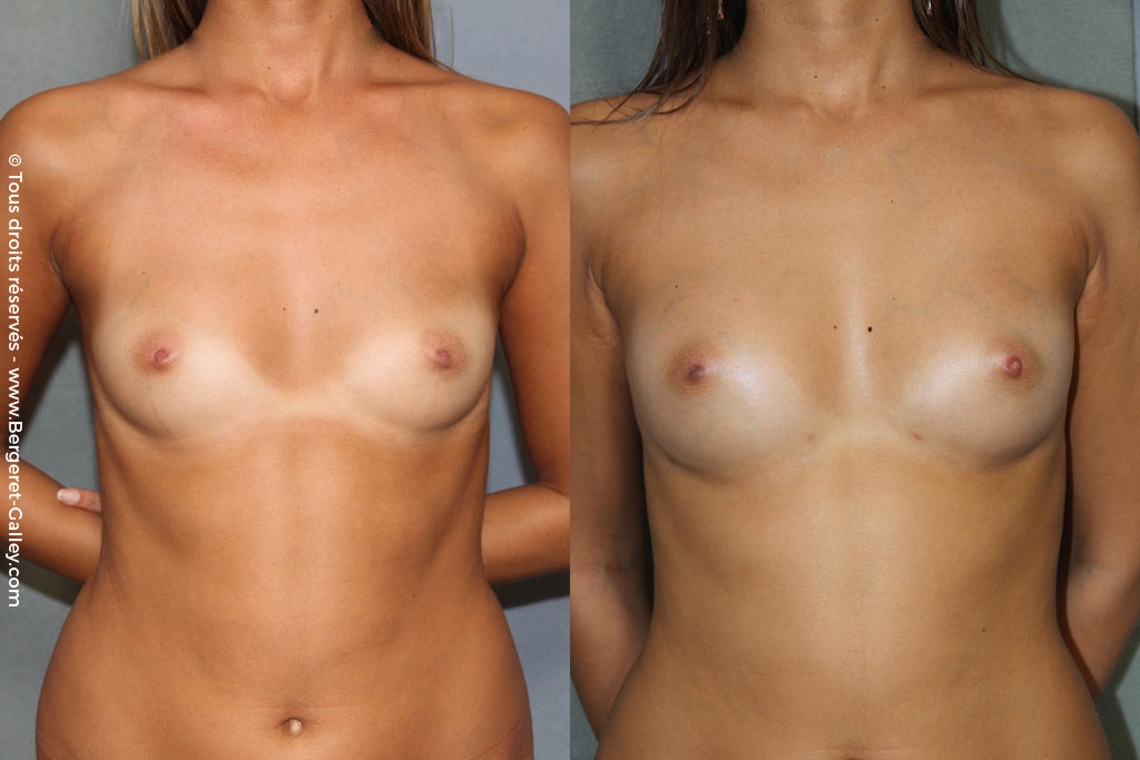 Lipofilling breasts