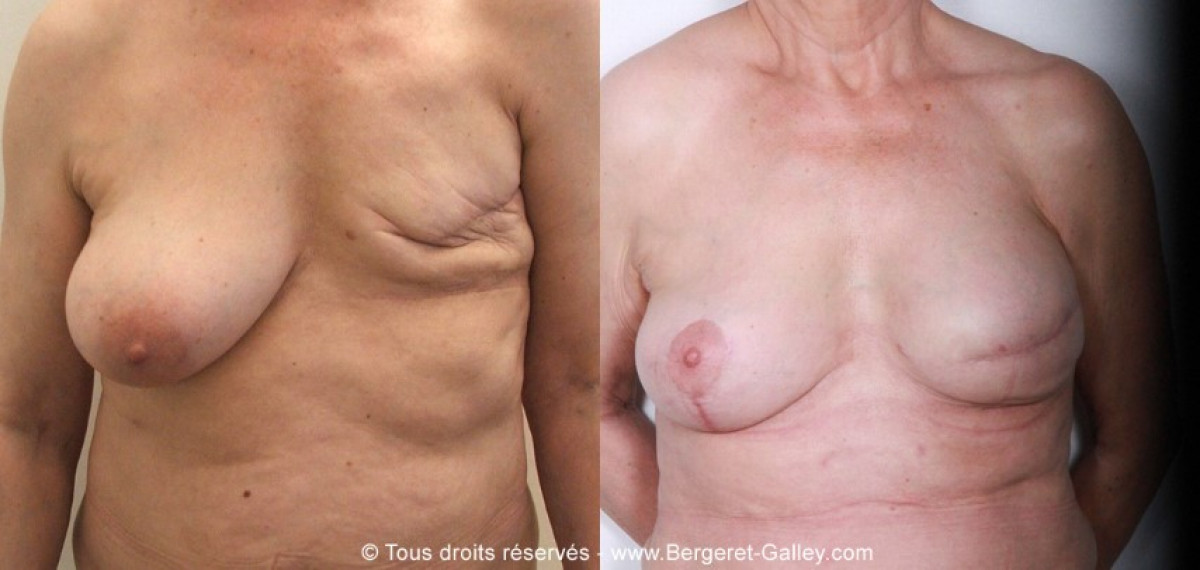 Before/After breast Reconstruction