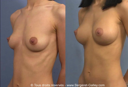 lipoffiling seins avant/après