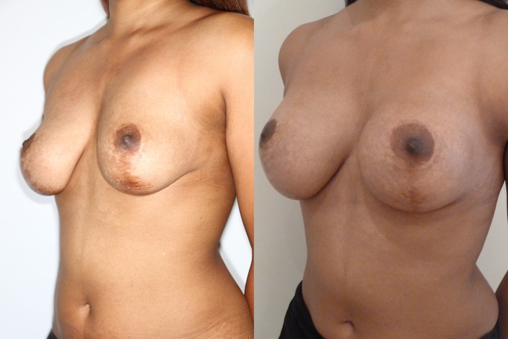 Лифтинг груди + имплантаты