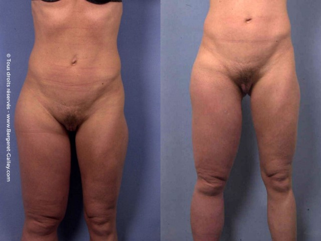 Liposuction of congenital malformation