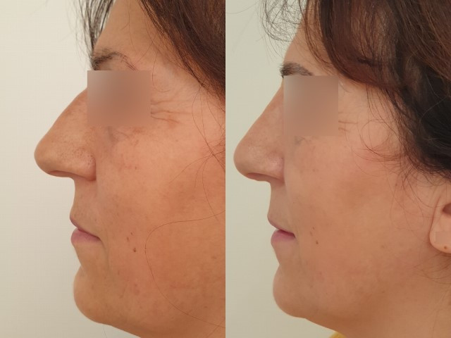 Résultat avant/après rhinoplastie