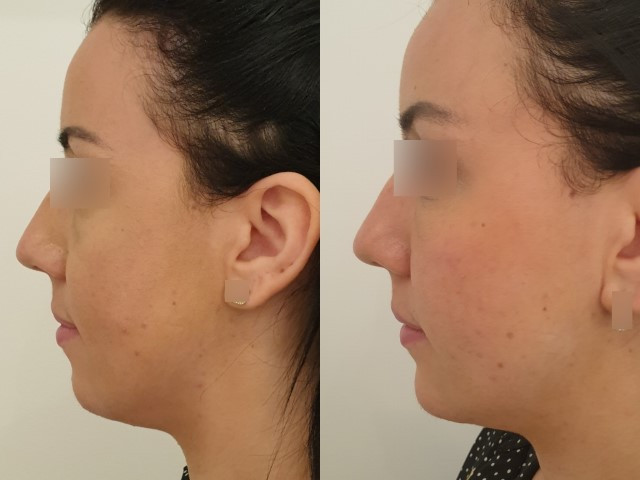 Lipofilling du visage