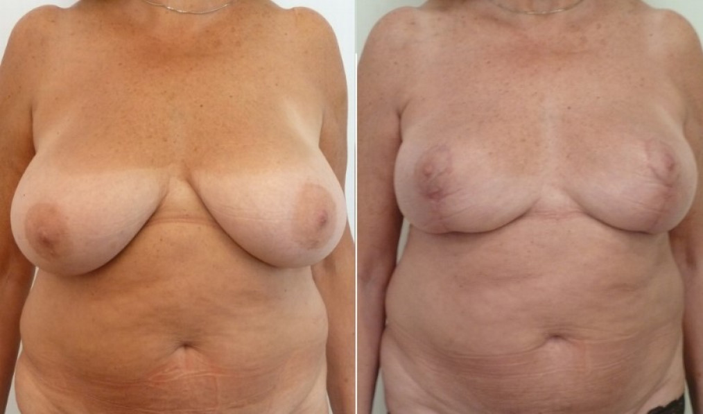 Breast reduction with URGOTOUCH