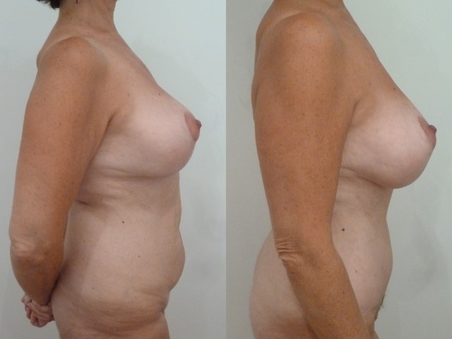 abdominoplastie