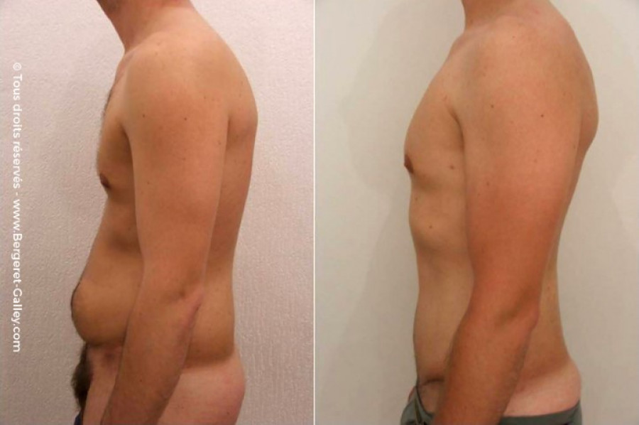 Men Abdominoplasty